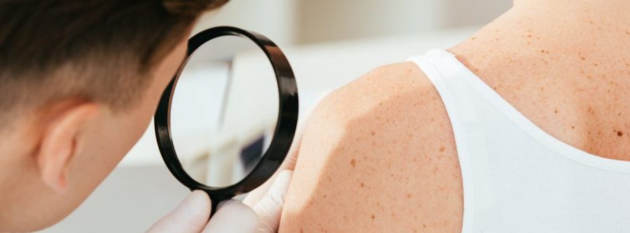 invalidità civile per melanoma